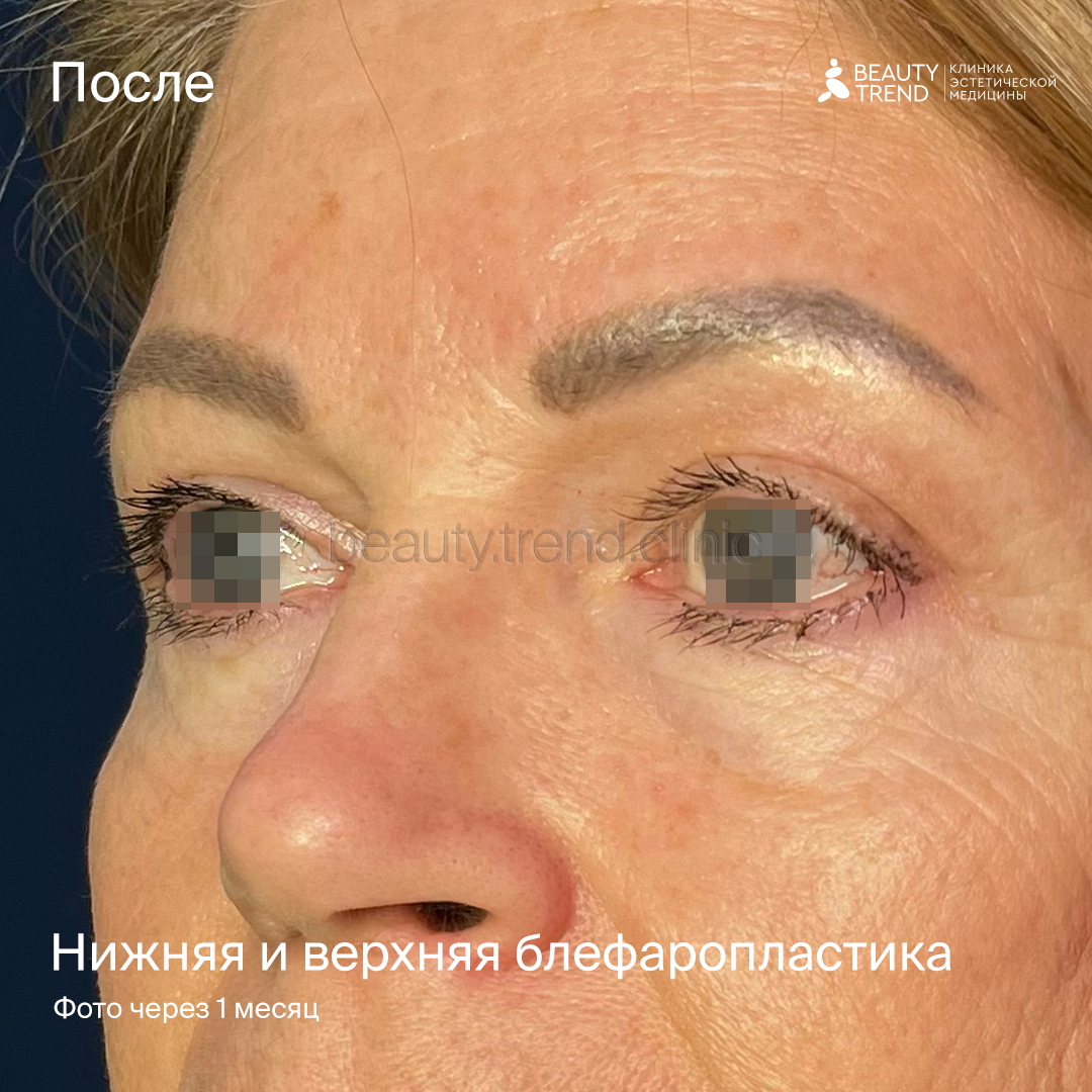 Верхняя блефаропластика, нижняя блефаропластика - после 1